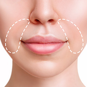 a woman's face after a Nasolabial fold treatments, with a dotted area highlighting the treated area