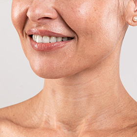 a woman's face after a marionette lines treatment